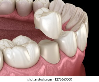 Dental Crown Premolar Tooth Assembly Process. Medically Accurate 3D Illustration Of Human Teeth Treatment