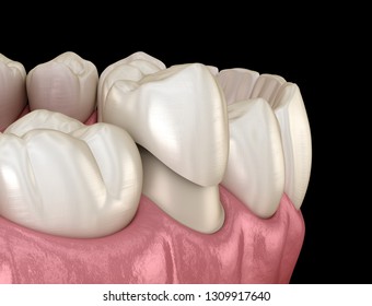 Dental Crown Premolar Tooth Assembly Process. Medically Accurate 3D Illustration Of Human Teeth Treatment