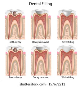 Dental Fillings