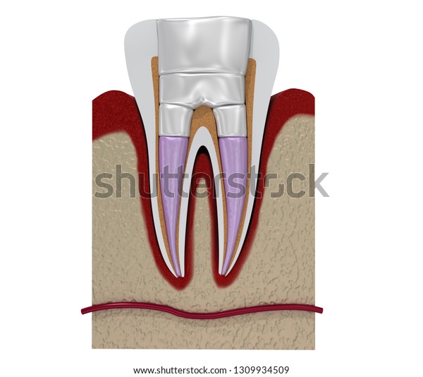 Dental Fillings Procedure Diagramm 3d Illustration Stock Illustration 1309934509