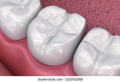 Dental fissure fillings, Medically accurate 3D illustration