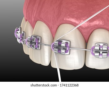 Dental Floss Cleaning Braces Process. Medically Accurate 3D Illustration Of Oral Hygiene.