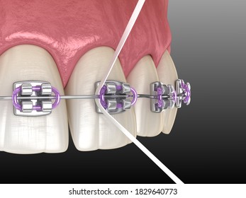 Dental Floss Cleaning Braces Process. Medically Accurate 3D Illustration Of Oral Hygiene.