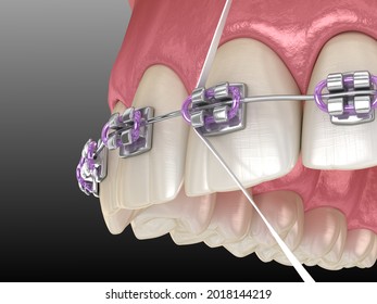 Dental Floss Cleaning Braces Process. Medically Accurate 3D Illustration Of Oral Hygiene.