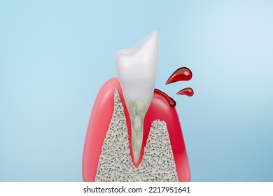 Enfermedad de Goma Dental, sangrado en la raíz de los dientes sobre fondo azul. Representación 3D.