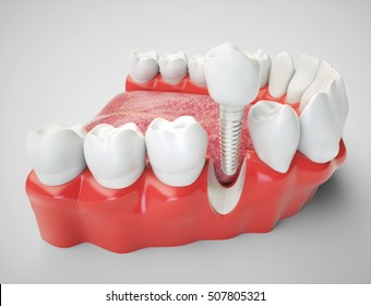 Dental Implant - 3d Rendering