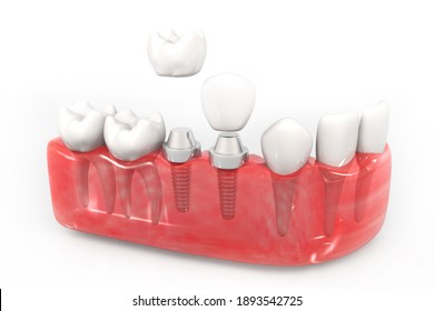 Dental Implant Installation Process. 3d Illustration