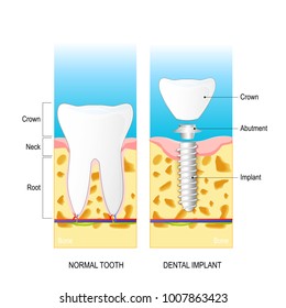 Dental Implant. Normal Human Tooth And Prosthesis. Dental Anatomy: Root, Neck, Crown. Structure Of Dental Implant: Crown, Abutment And Implant. Diagram For Medical Use