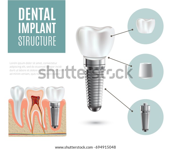 Dental Implant Structure Medical Pictorial Educative Stock Illustration ...