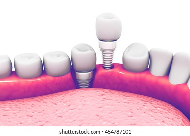 Dental Implant Structure.3d Render