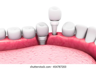 Dental Implant Structure.3d Render