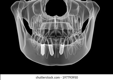 Dental Implant And Teeth. X-ray View