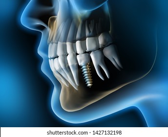 Dental Implantat - Implant - 3D Illustration