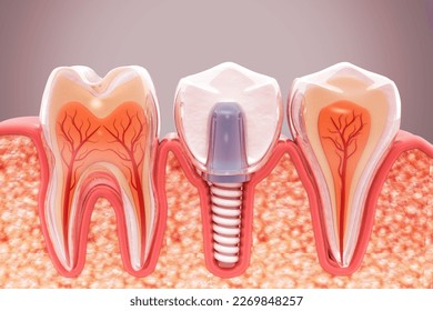 Dental implantation, jaw bones and healthy roots, implant screw and abutment, dentist and orthodontist treatment, 3d illustration - Powered by Shutterstock