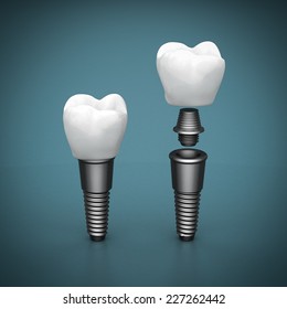 Dental Implants On Beautiful Blue Background Stock Illustration ...