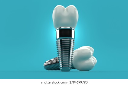 Dental Implants On Blue Background. 3d Illustration