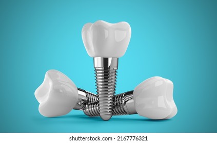 Dental Implants On Blue Background 3d Stock Illustration 2167776321 ...