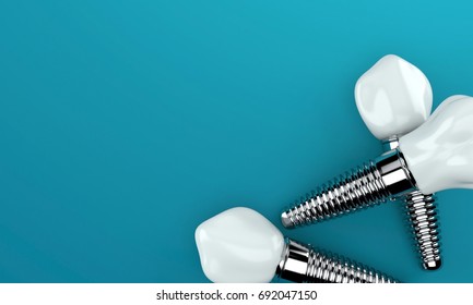 Dental Implants On Blue Background. 3d Illustration