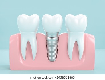 Dental implants on light blue background - Powered by Shutterstock