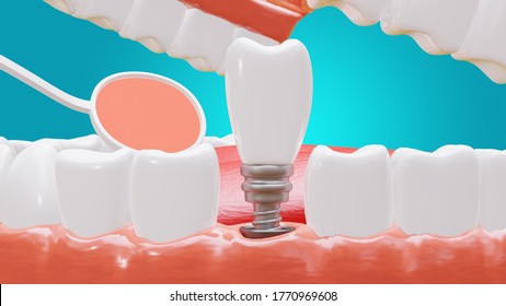 Dental Implants surgery concept, dentistry denture, Dental denture on green background. clipping part. 3D render.
