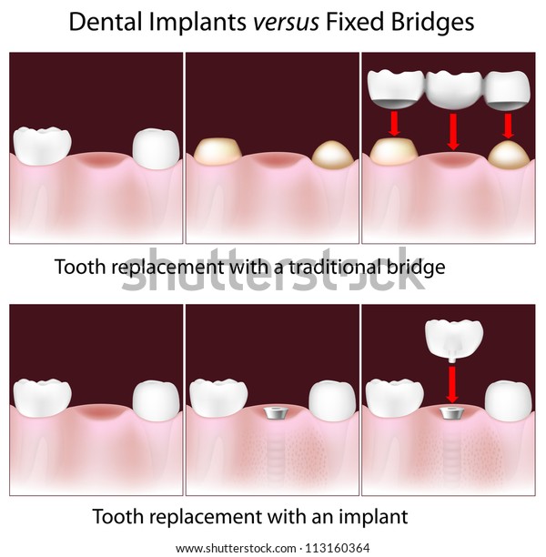 Dental Implants Versus Fixed Bridges Stock Illustration 113160364