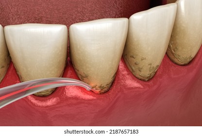 Dental Laser Remove Tartar And Thin Layer Of Infected Skin. Dental 3D Illustration