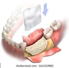 Dental Membrane Flying In Air Follow By Arrow Down, To Be Attached To Bone Graft On Lower Jaw After Bone Loss. Vertical Bone Regeneration. 3D Illustration. Bone Grafting. Augmentation Surgery.