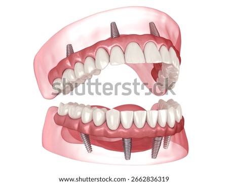 Dental prosthesis based on 4 implants. Dental 3D illustration