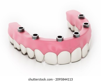 43,030 Dental Prosthesis Images, Stock Photos & Vectors | Shutterstock