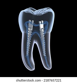 Dental Steel Post Inside Molar Teeth, Xray View. Dental Endodontic Treatment 3D Illustration