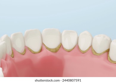 Dental tartar adhering to lower front teeth, oral hygiene and professional dental care concept. - Powered by Shutterstock