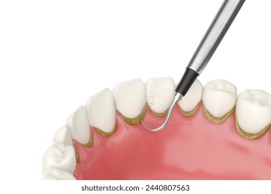 Dental tartar removal tool effectively eliminating dental calculus, oral hygiene and health concept. 3D rendering. - Powered by Shutterstock