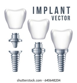 Dental tooth implant and parts illustration. Implantation dentistry and care to teeth