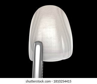 Dental Veneer For Central Incisor. 3D Illustration