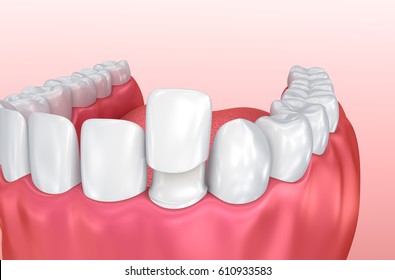 Dental Veneers: Porcelain Veneer Installation Procedure. 3d Illustration