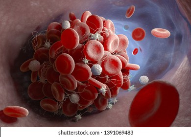 Depiction of a blood clot forming inside a blood vessel. 3D illustration
