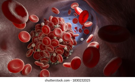 Depiction Of A Blood Clot Forming Inside A Blood Vessel. 3D Illustration