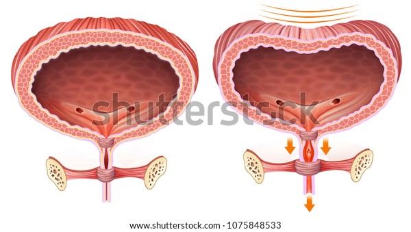 尿と正常な滞留の問題がある膀胱の説明的で比較的解剖学的なイラスト のイラスト素材