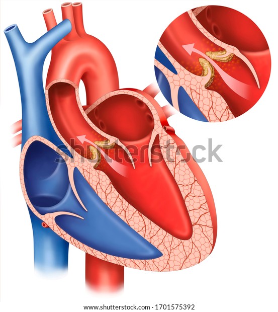 Descriptive illustration of aortic\
stenosis, valvular heart disease, characterized by abnormal\
narrowing of the orifice of the aortic valve of the\
heart.