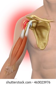 Descriptive Illustration Of A Biceps Tendinitis Tendon