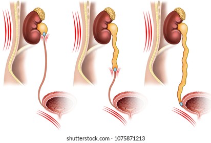 Descriptive illustration of kidney stones obstructing the passage of urine causing pain in the part where the kidney is located.