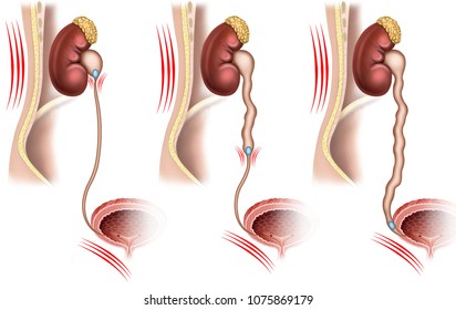 Descriptive illustration of kidney stones preventing the transport of urine from the kidney to the bladder.