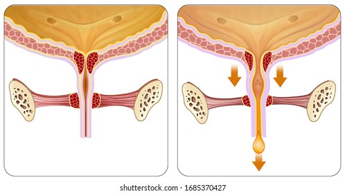 Descriptive Illustration Of The Part Of The Bladder Where Urinary Incontinence Problems Originate.