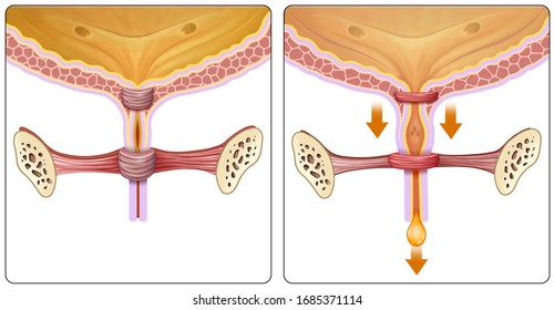 Descriptive Illustration Of The Part Of The Bladder Where Urinary Incontinence Problems Originate.