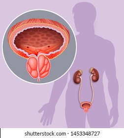 inflamación de la próstata okid inflamación de la próstata okid
