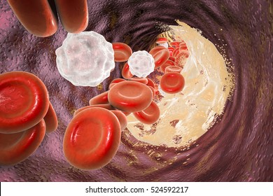 Destruction of atheroma plaque inside artery, 3D illustration. Conceptual image for treatment of coronary artery disease, atherosclerosis, cerebral infarction