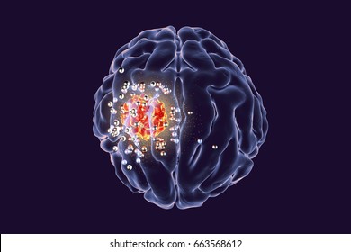 Destruction Of Brain Tumor By Nanoparticles, 3D Illustration. Conceptual Image For Brain Cancer Treatment Using Nanotechnology