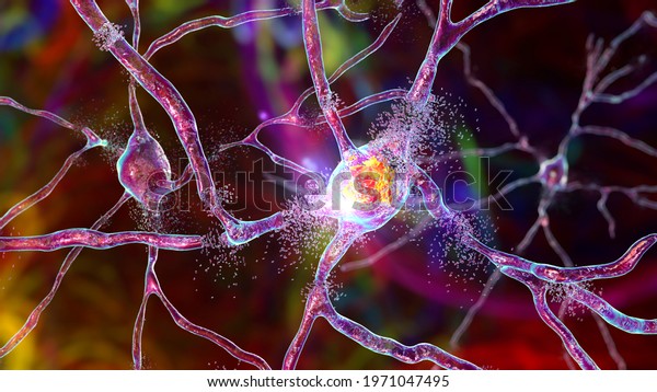 Destruction of neurons of Dorsal striatum,\
conceptual 3D illustration. Dorsal striatum is a nucleus in the\
brain basal ganglia, its neurons are damaged in Huntingon\'s disease\
and other\
choreas