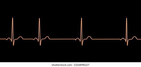 A detailed 3D illustration of an Electrocardiogram ECG displaying sinus arrhythmia, a condition characterized by irregular heart rhythms originating from the sinus node. - Powered by Shutterstock