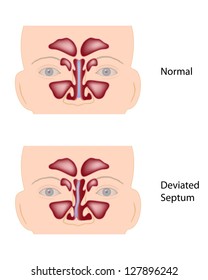 Deviated Nasal Septum